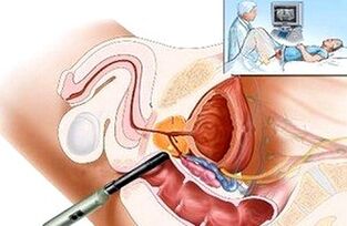 Diagnose Prostatitis