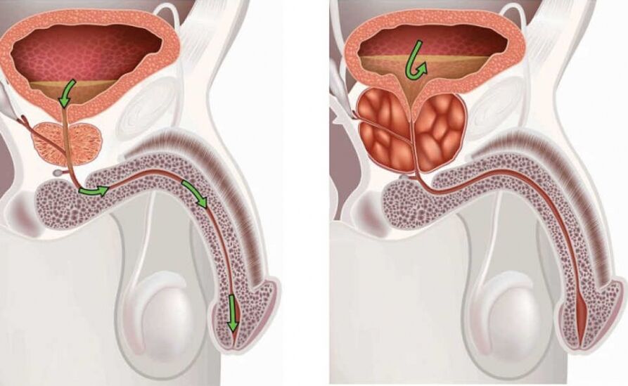 Healthy and inflamed prostate gland.