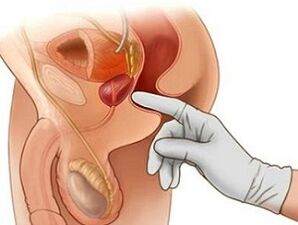 Prostate massage for the treatment of prostatitis in men.