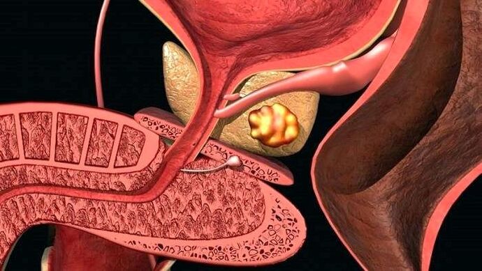 Stone deposits in the prostate with calculous prostatitis.