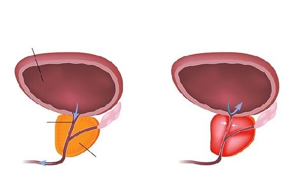 normal and inflamed prostate